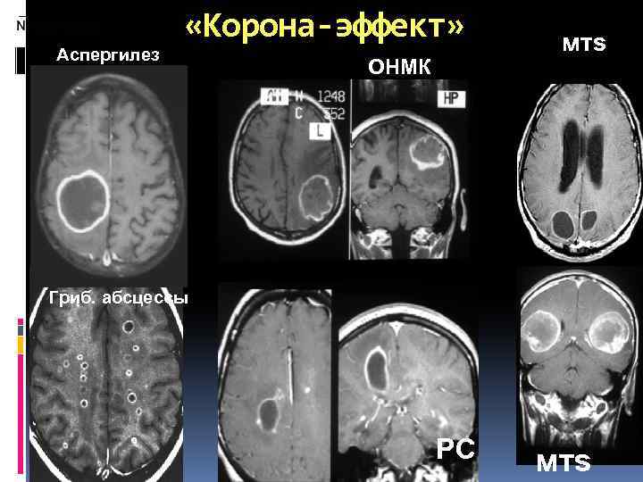 Аспергилез «Корона-эффект» ОНМК мтs Гриб. абсцессы РС мтs 
