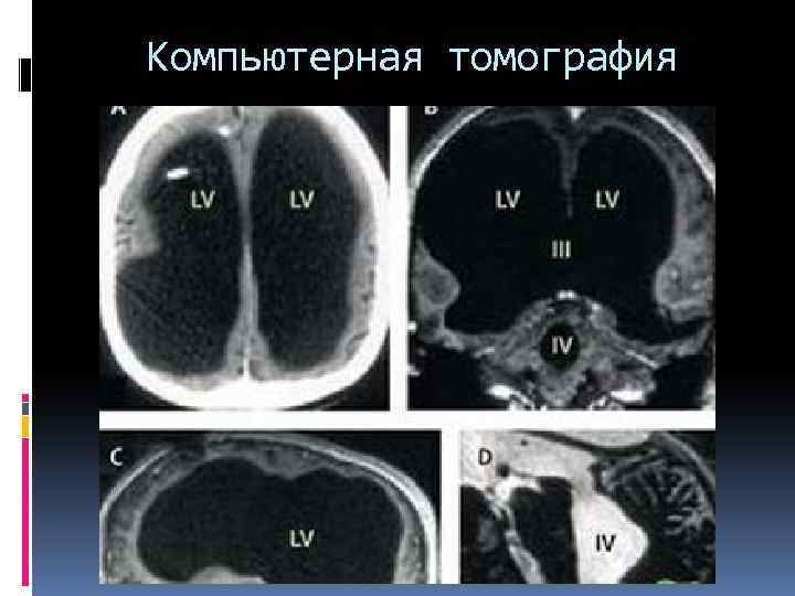 Компьютерная томография 