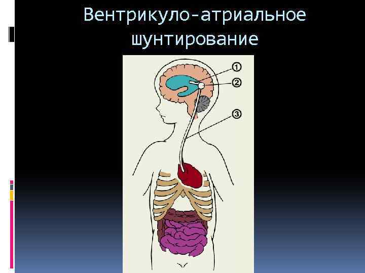 Вентрикуло-атриальное шунтирование 