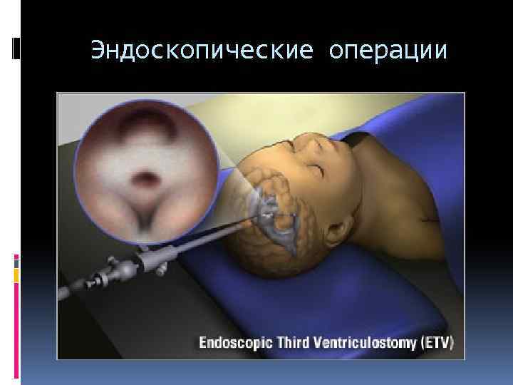 Эндоскопические операции 