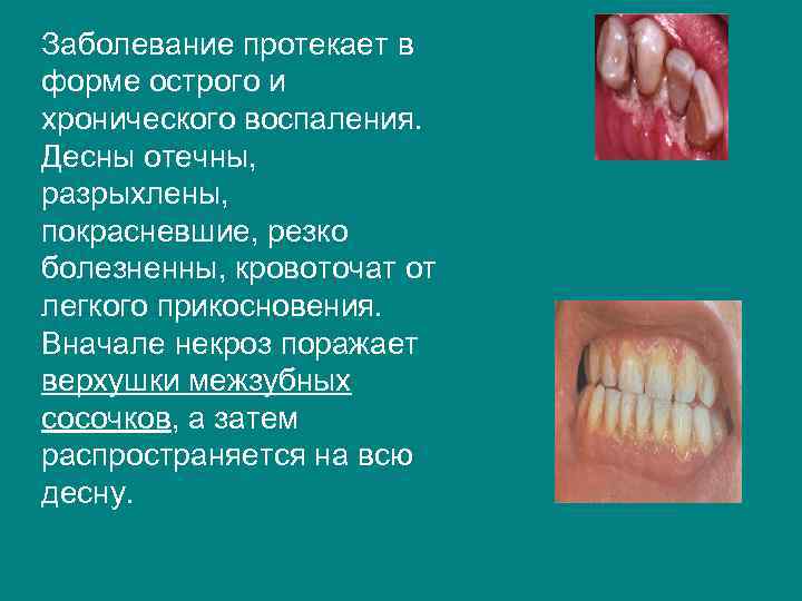 Заболевание протекает в форме острого и хронического воспаления. Десны отечны, разрыхлены, покрасневшие, резко болезненны,