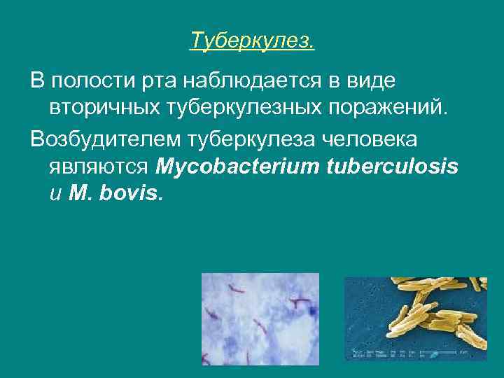 Туберкулез. В полости рта наблюдается в виде вторичных туберкулезных поражений. Возбудителем туберкулеза человека являются