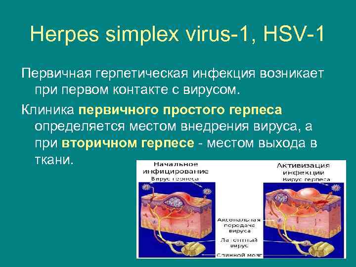 Herpes simplex virus-1, HSV-1 Первичная герпетическая инфекция возникает при первом контакте с вирусом. Клиника