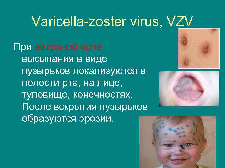 Varicella-zoster virus, VZV При ветряной оспе высыпания в виде пузырьков локализуются в полости рта,