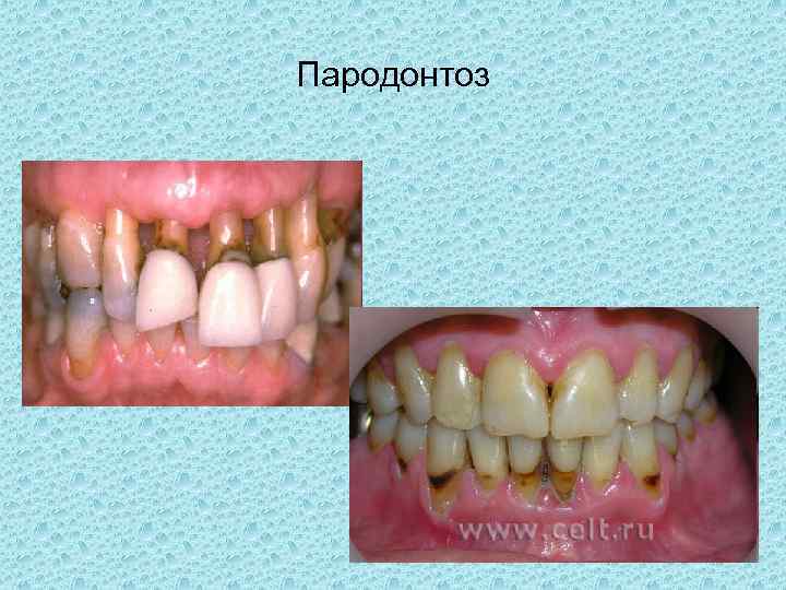 Пародонтоз 