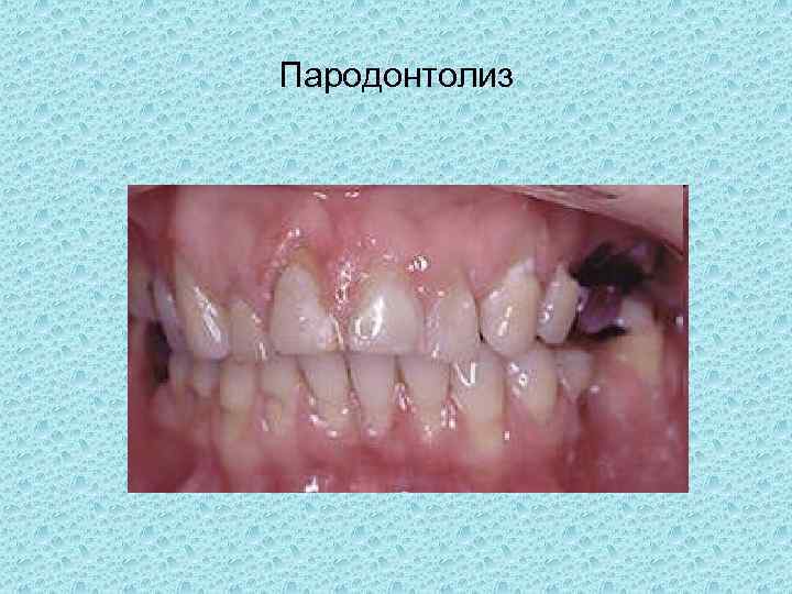 Пародонтолиз 