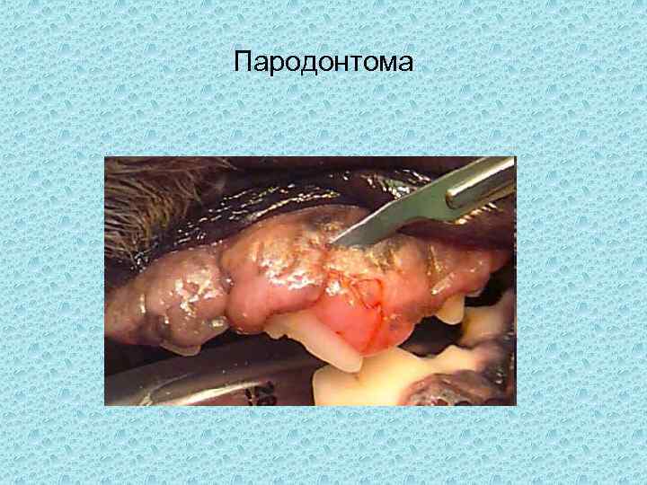 Пародонтома 