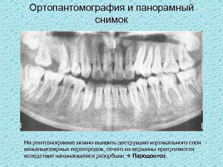 Рентгенологическая картина костной ткани челюстей при пародонтите тяжелой степени