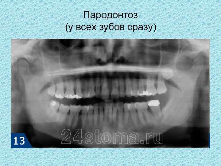 Пародонтоз (у всех зубов сразу) 