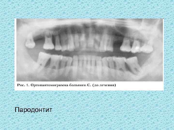 Пародонтит 