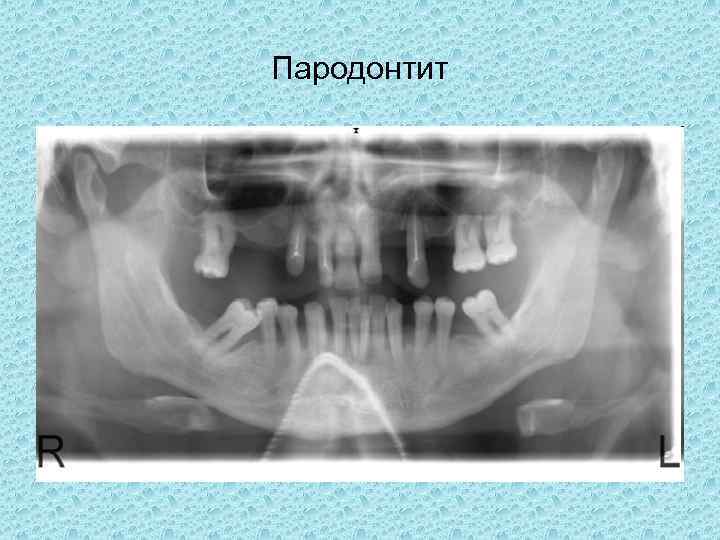 Рентгенологическая картина костной ткани челюстей при пародонтите тяжелой степени