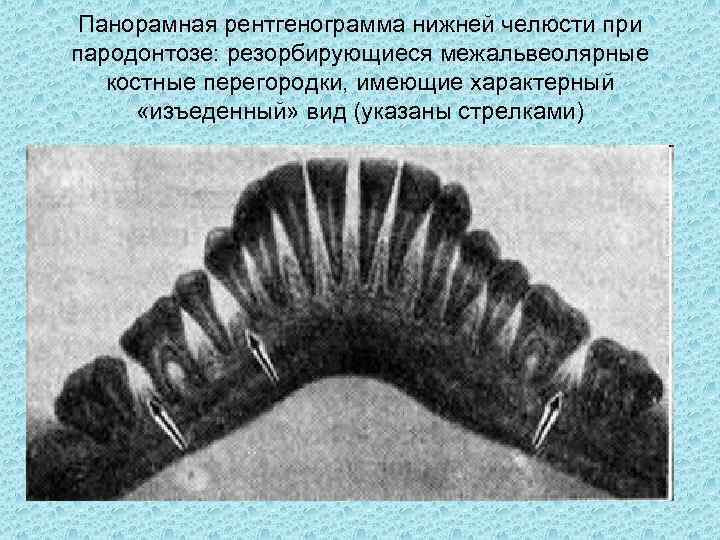 Панорамная рентгенограмма нижней челюсти при пародонтозе: резорбирующиеся межальвеолярные костные перегородки, имеющие характерный «изъеденный» вид