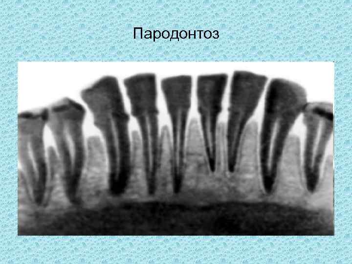 Пародонтоз 