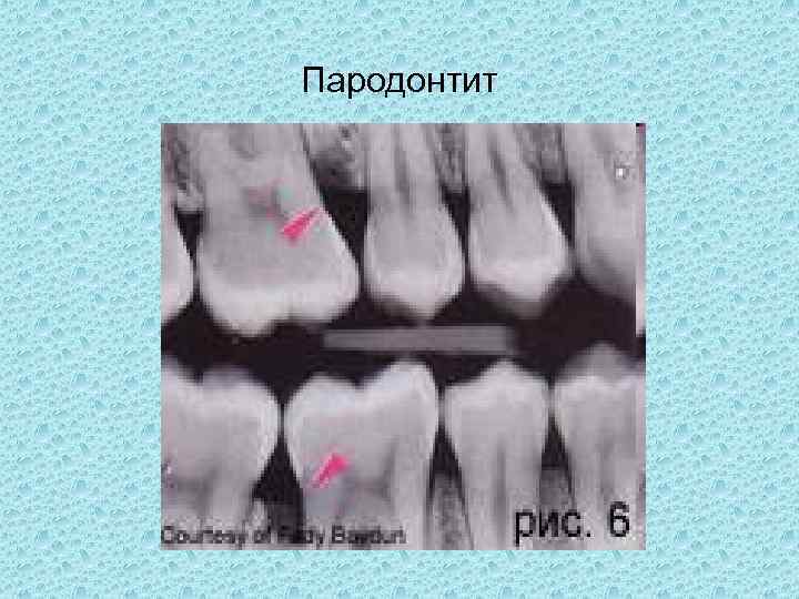 Рентгенологическая картина пародонтоз