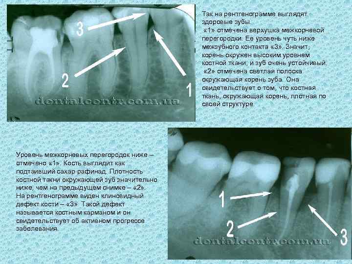 Так на рентгенограмме выглядят здоровые зубы. « 1» отмечена верхушка межкорневой перегородки. Ее уровень