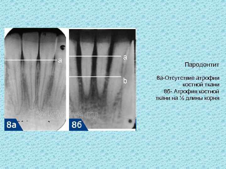 Пародонтит 8 а-Отсутствие атрофии костной ткани 8 б- Атрофия костной ткани на ½ длины