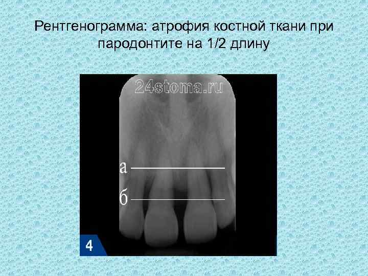 Рентгенологическая картина костной ткани челюстей при пародонтите тяжелой степени