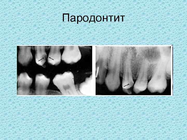 Пародонтит 
