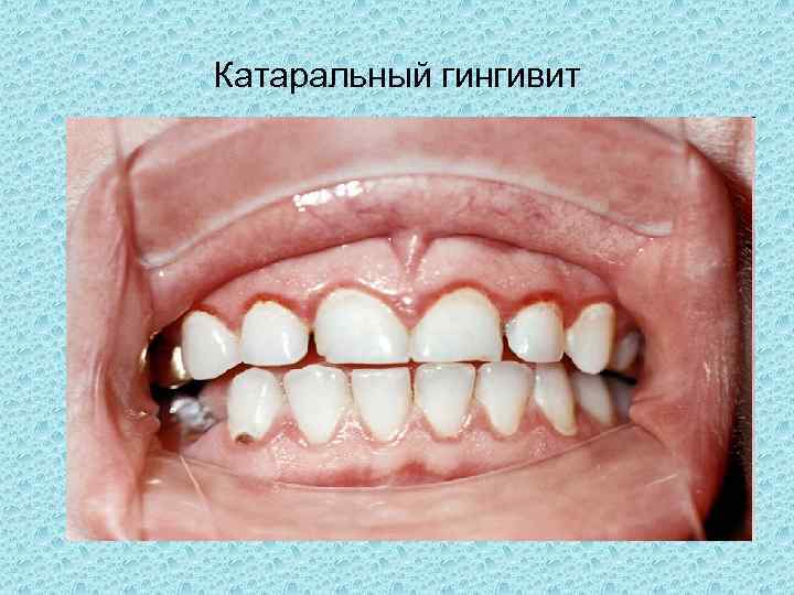 Катаральный гингивит 