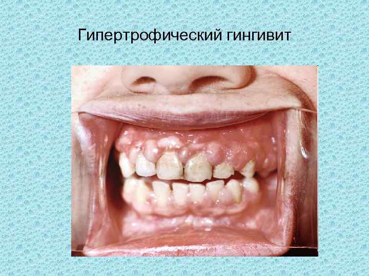 Гипертрофический гингивит 