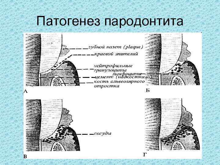 Этиология патогенез пародонта. Патогенез пародонтита. Пародонтит этиология патогенез. Патогенез пародонтита схема. Этиология очагового пародонтита.