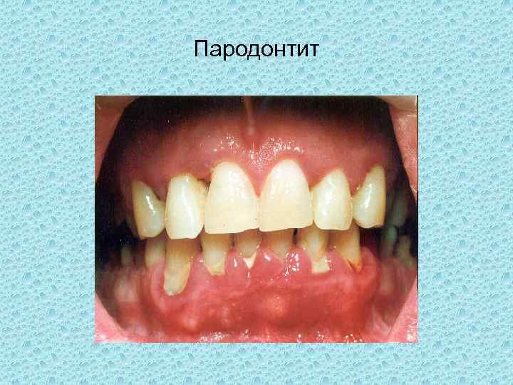 Пародонтит 