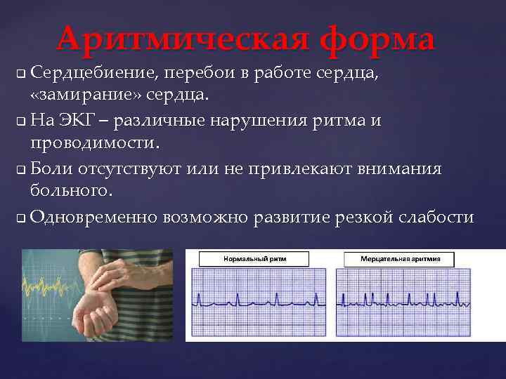 Аритмическая форма Сердцебиение, перебои в работе сердца, «замирание» сердца. q На ЭКГ – различные