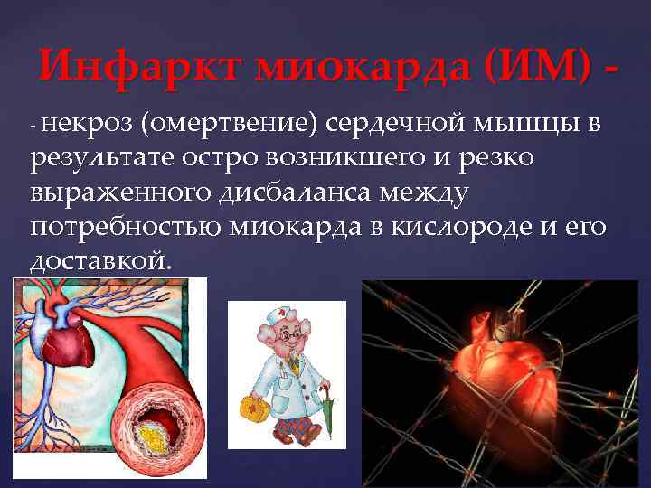 Инфаркт миокарда (ИМ) - некроз (омертвение) сердечной мышцы в результате остро возникшего и резко