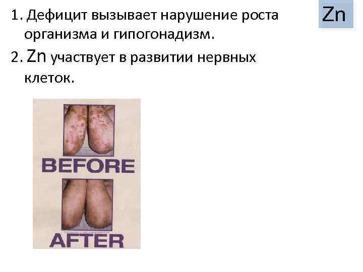 1. Дефицит вызывает нарушение роста организма и гипогонадизм. 2. Zn участвует в развитии нервных
