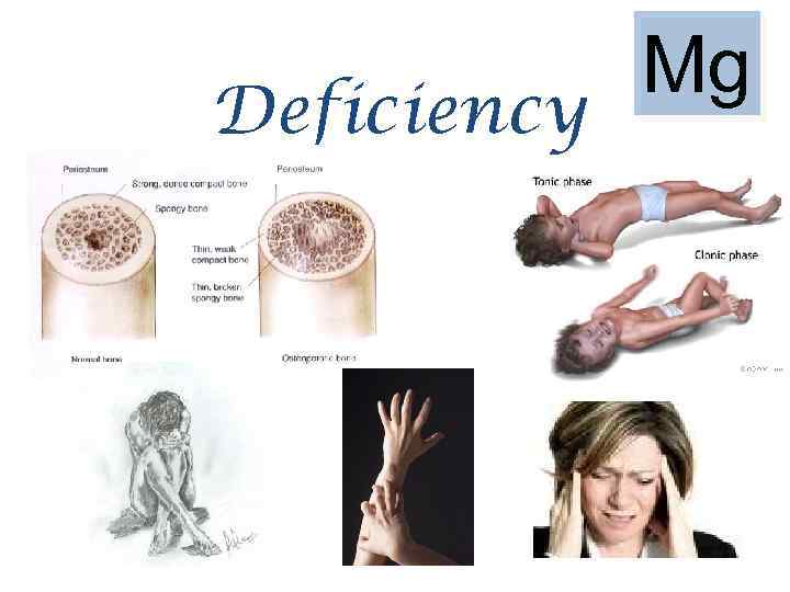 Deficiency Mg 