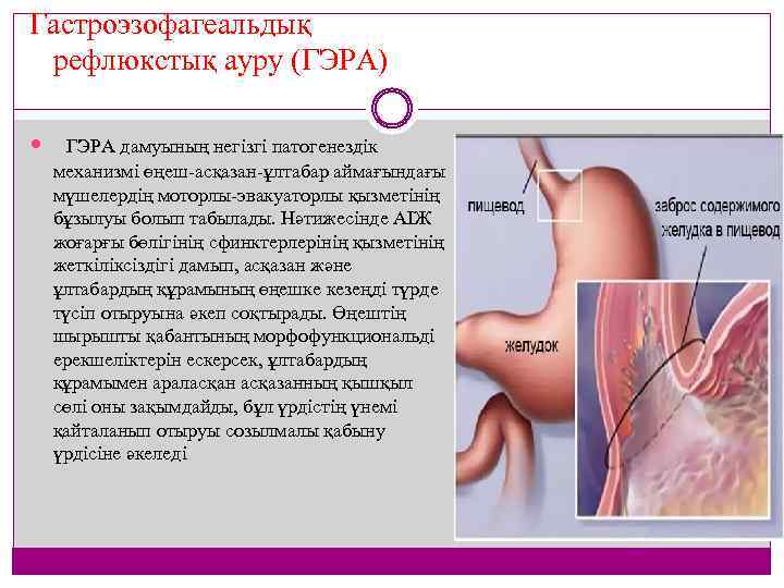 Гастроэзофагеальдық рефлюкстық ауру (ГЭРА) ГЭРА дамуының негізгі патогенездік механизмі өңеш асқазан ұлтабар аймағындағы мүшелердің