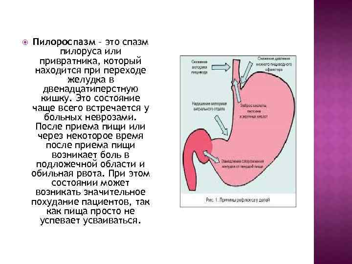  Пилороспазм – это спазм пилоруса или привратника, который находится при переходе желудка в