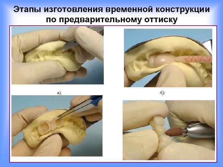 Этапы изготовления временной конструкции по предварительному оттиску 