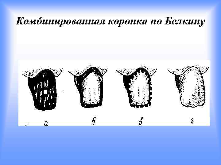 Комбинированная коронка по Белкину 