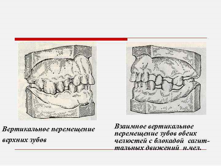 Частичные дефекты зубных рядов