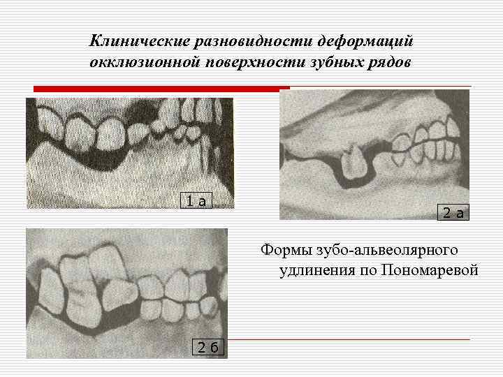 Клиническая картина при частичном отсутствии зубов