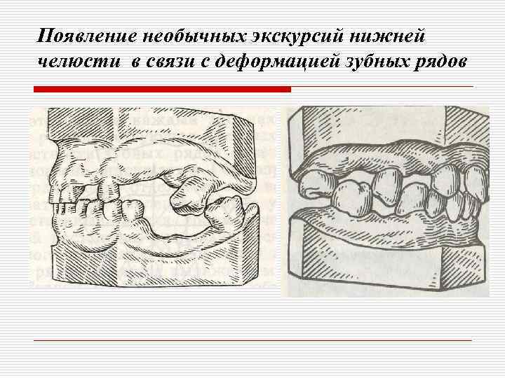 Появление необычных экскурсий нижней челюсти в связи с деформацией зубных рядов 