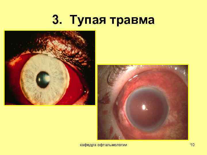 3. Тупая травма кафедра офтальмологии 10 