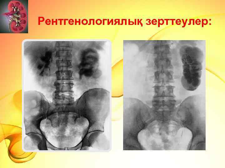 Рентгенологиялық зерттеулер: 