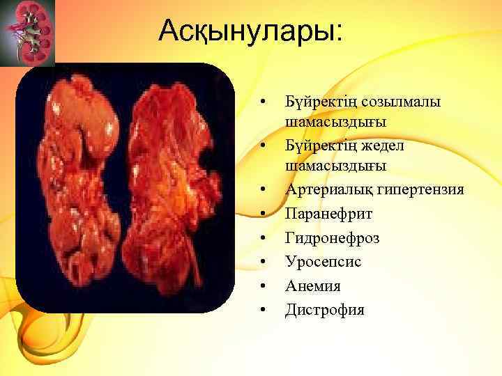 Асқынулары: • • Бүйректің созылмалы шамасыздығы Бүйректің жедел шамасыздығы Артериалық гипертензия Паранефрит Гидронефроз Уросепсис