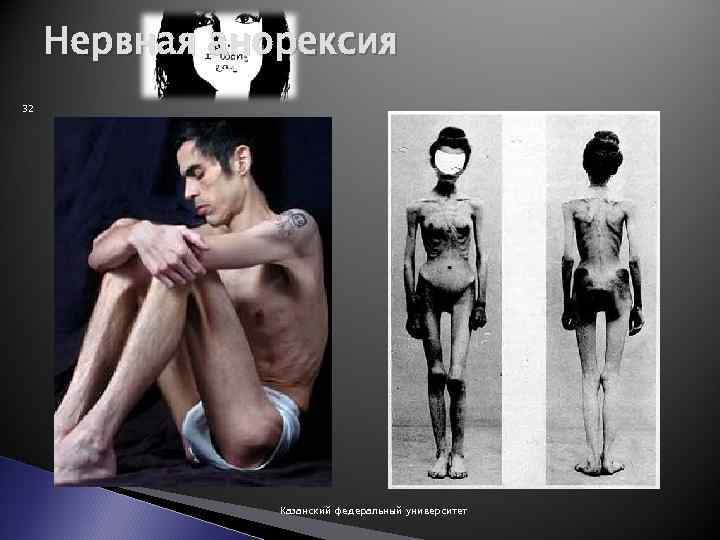 Нервная анорексия 32 Казанский федеральный университет 