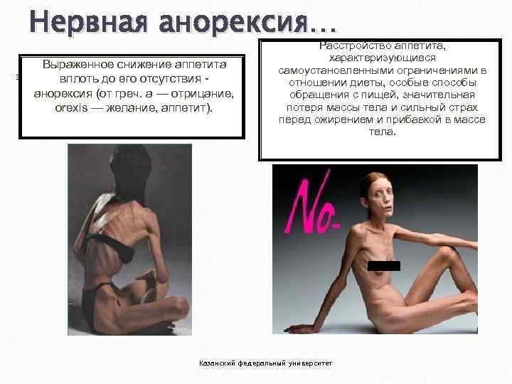 Нервная анорексия… 33 Выраженное снижение аппетита вплоть до его отсутствия анорексия (от греч. а