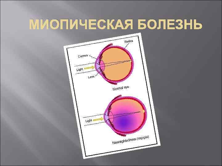 МИОПИЧЕСКАЯ БОЛЕЗНЬ 