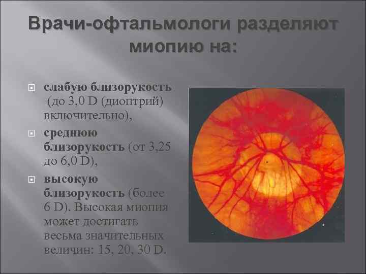 Врачи-офтальмологи разделяют миопию на: слабую близорукость (до 3, 0 D (диоптрий) включительно), среднюю близорукость