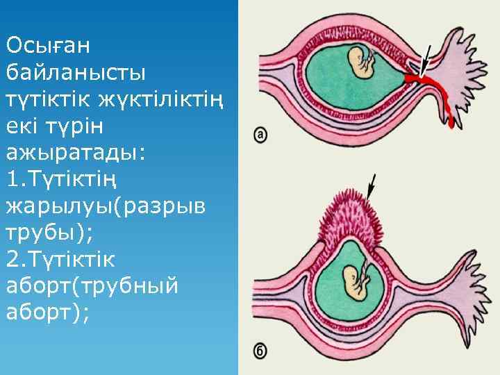 Осыған байланысты түтіктік жүктіліктің екі түрін ажыратады: 1. Түтіктің жарылуы(разрыв трубы); 2. Түтіктік аборт(трубный