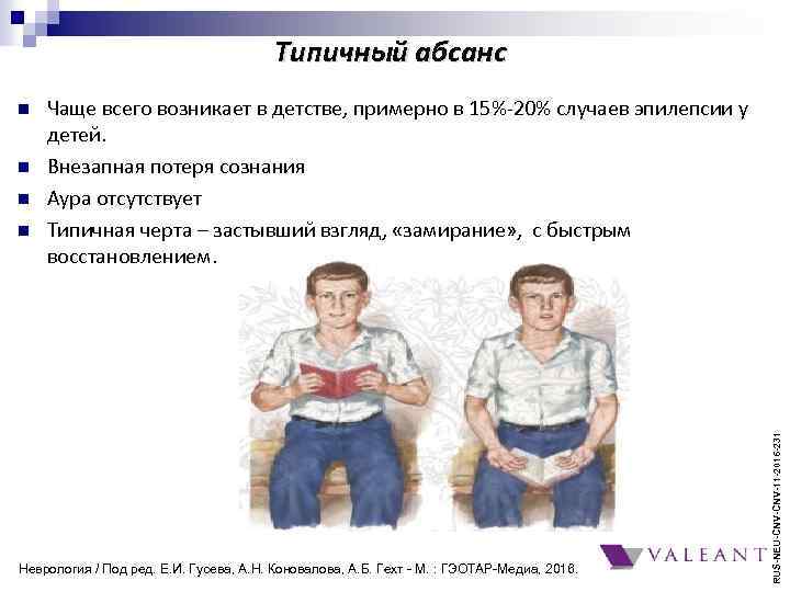 Типичный абсанс n n n Чаще всего возникает в детстве, примерно в 15%-20% случаев