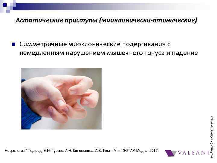 Астатические приступы (миоклонически-атонические) Симметричные миоклонические подергивания с немедленным нарушением мышечного тонуса и падение Неврология