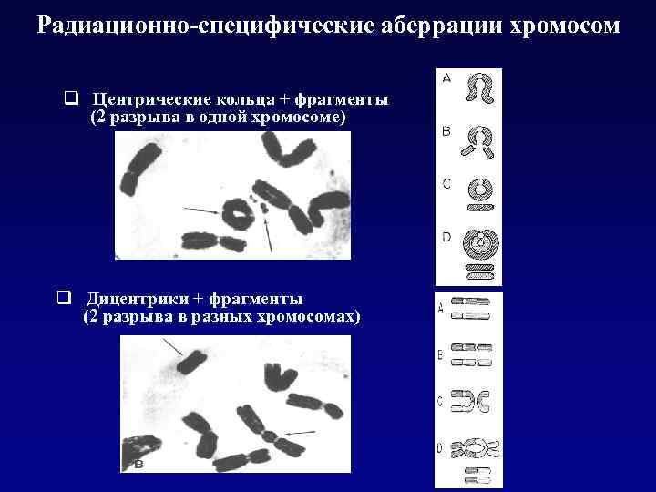 Радиационно-специфические аберрации хромосом q Центрические кольца + фрагменты (2 разрыва в одной хромосоме) q