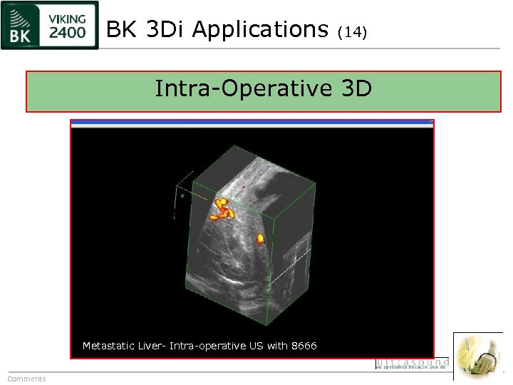 BK 3 Di Applications (14) Intra-Operative 3 D Metastatic Liver- Intra-operative US with 8666