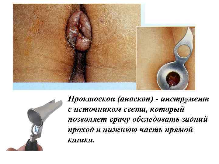 Проктоскоп (аноскоп) - инструмент с источником света, который позволяет врачу обследовать задний проход и